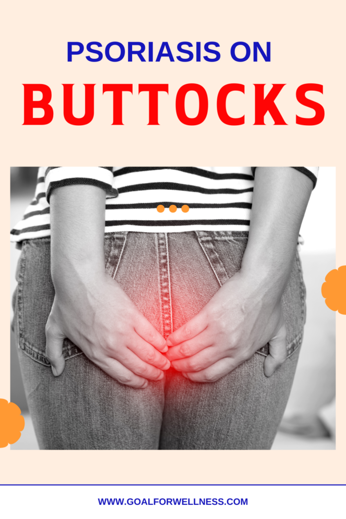 Psoriasis on Buttocks and Treatment