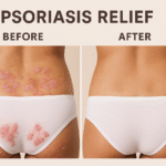 psoriasis relief
